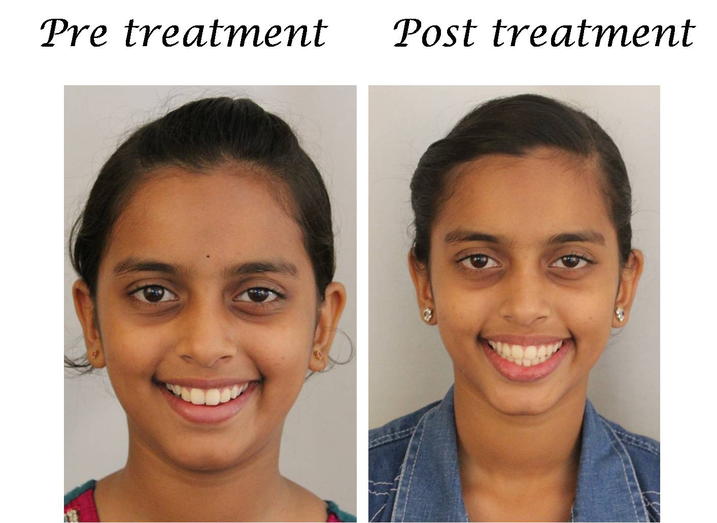 Orthodontic Treatment